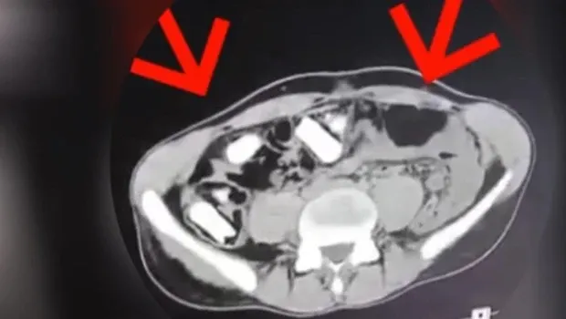 Röntgen çekilince ortaya çıktı: Midesinde kurye gibi uyuşturucuyu taşıyan şüpheli tutuklandı
