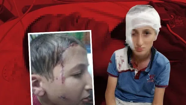 Yaşadığı kabustan sonra çocuğun yüzünde kalıcı izler kaldı: Mahkemeden 1.2 milyon lira tazminat kararı